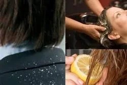 Dandruff Treatment