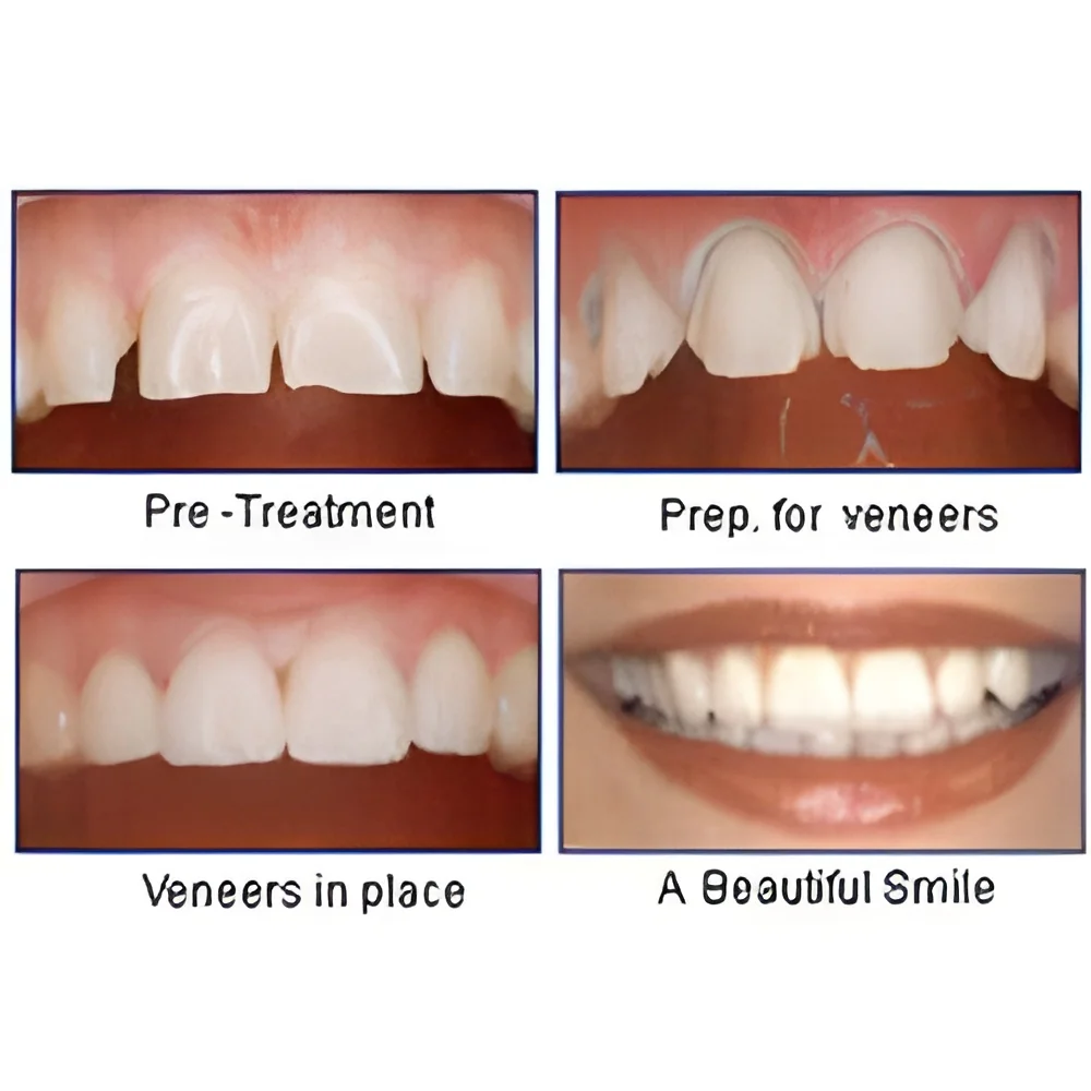 resizeImages/NDc2OQ==/mediabank/images/products/LaminatesVeneers1653165594_4769.webp